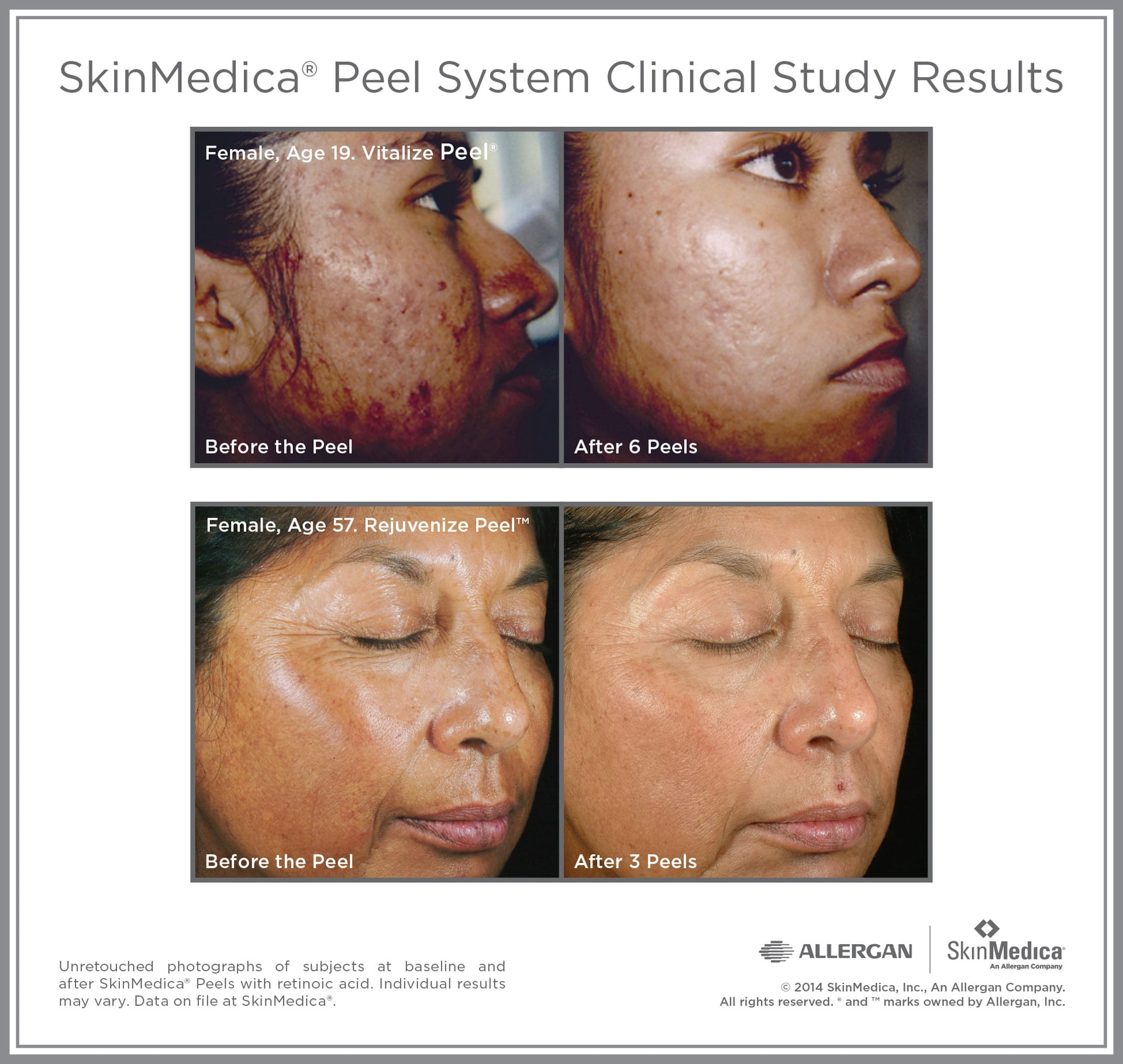 Vitalize Peel: Before and After
